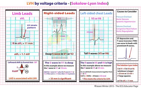 lvh voltage criteria by age.